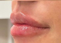 Fillers